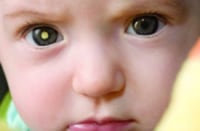 An infant with a white 'glow' in one pupil, indicating the possible presence of a retinoblastoma tumor