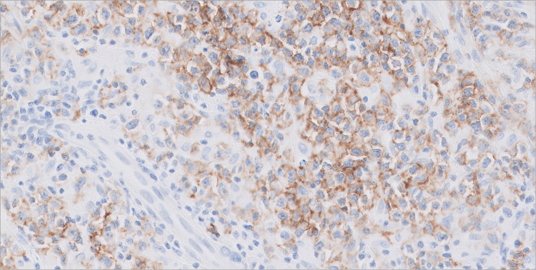 Small cell lung carcinoma stained with FLEX Anti-Synaptophysin, Code GA660, on Dako Omnis