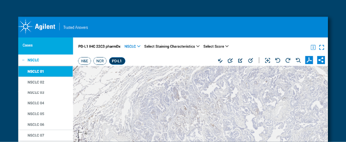 Image of the PD-L1 IHC 22C3 pharmDx NSCLC Online Atlas of Stains