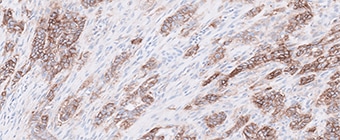 Gastric, GEJ, and Esophageal Adenocarcinoma teaser image