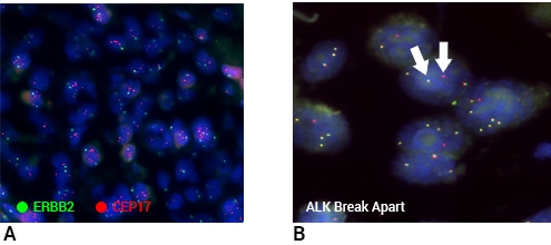 Figure 2. Representative images of ERBB2 FISH (A) and ALK Break Apart FISH (B) from the concordance study shown in Table 2.