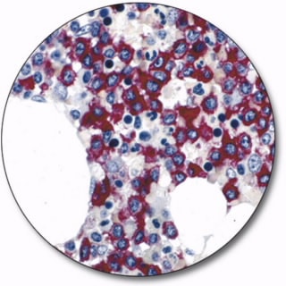 Leukaemia, Hairy Cell (Concentrate)