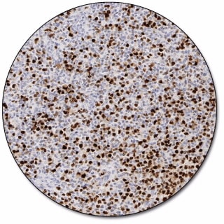 MUM1 Protein (Dako Omnis)