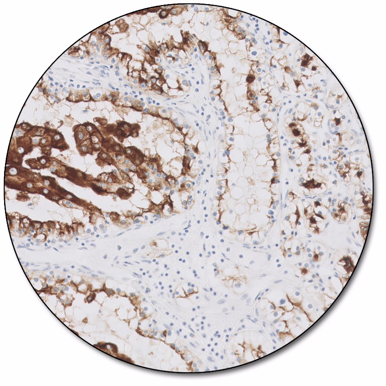 Renal Cell Carcinoma Marker (Dako Omnis)