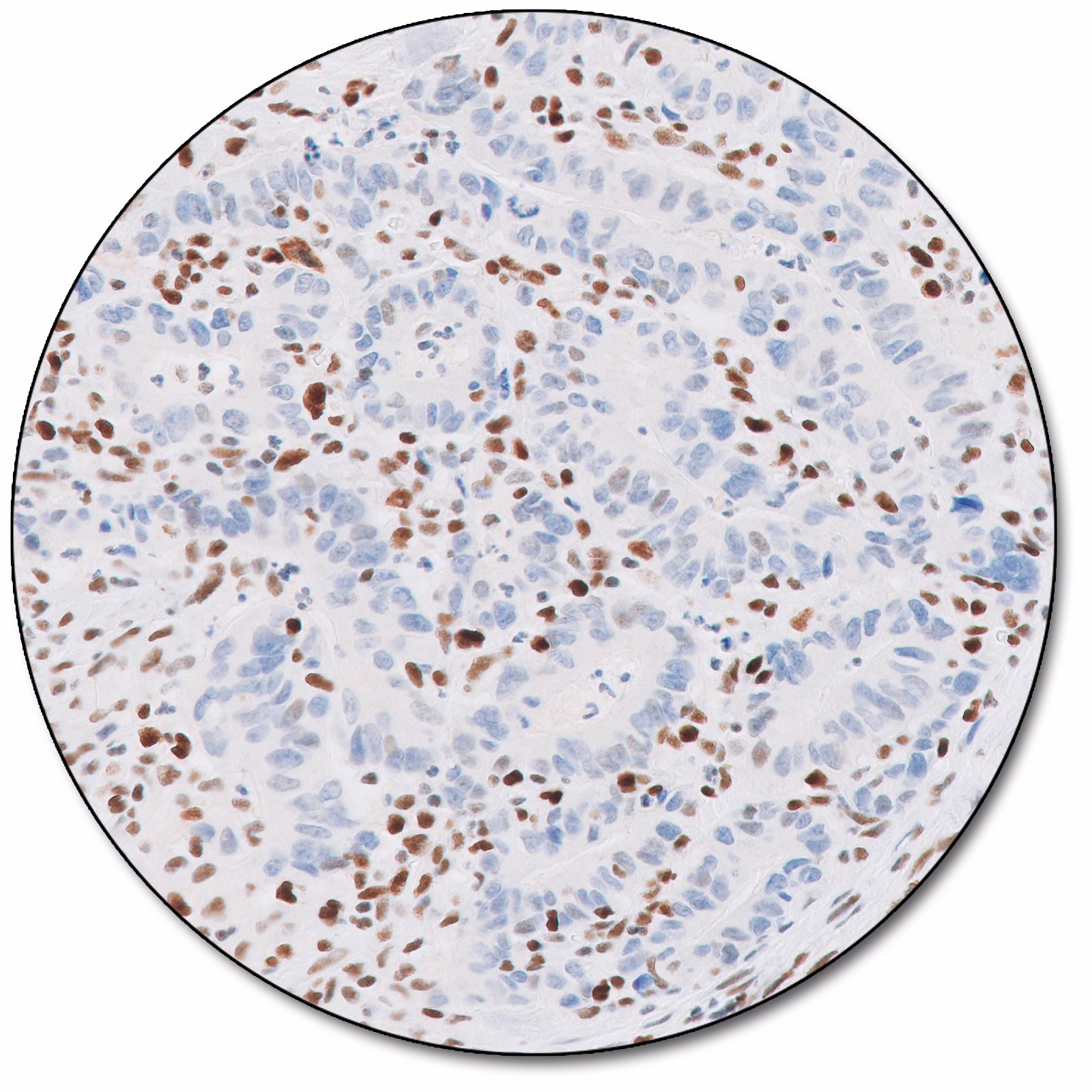 MutS Protein Homolog 6 (Dako Omnis)