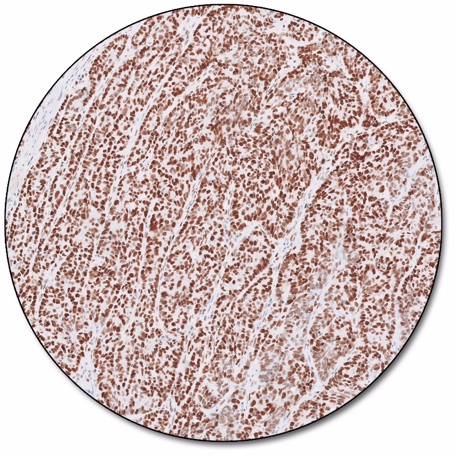 MutS Protein Homolog 6 (Dako Omnis)