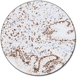 Progesterone Receptor (Dako Omnis)