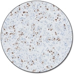 Progesterone Receptor (Dako Omnis)