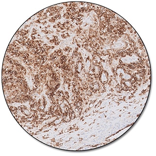 Epithelial Membrane Antigen (Dako Omnis)