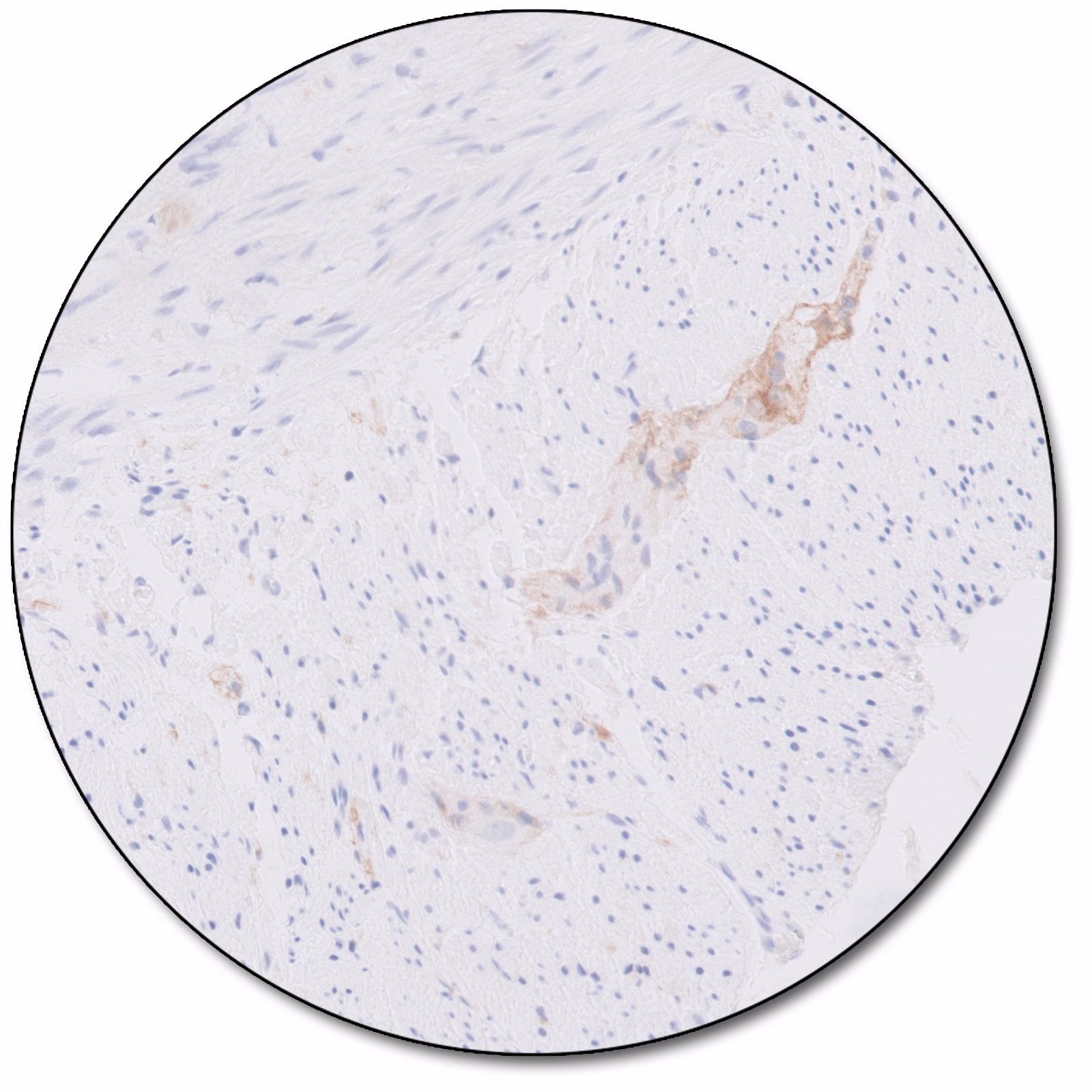 CD246, ALK Protein (Dako Omnis)
