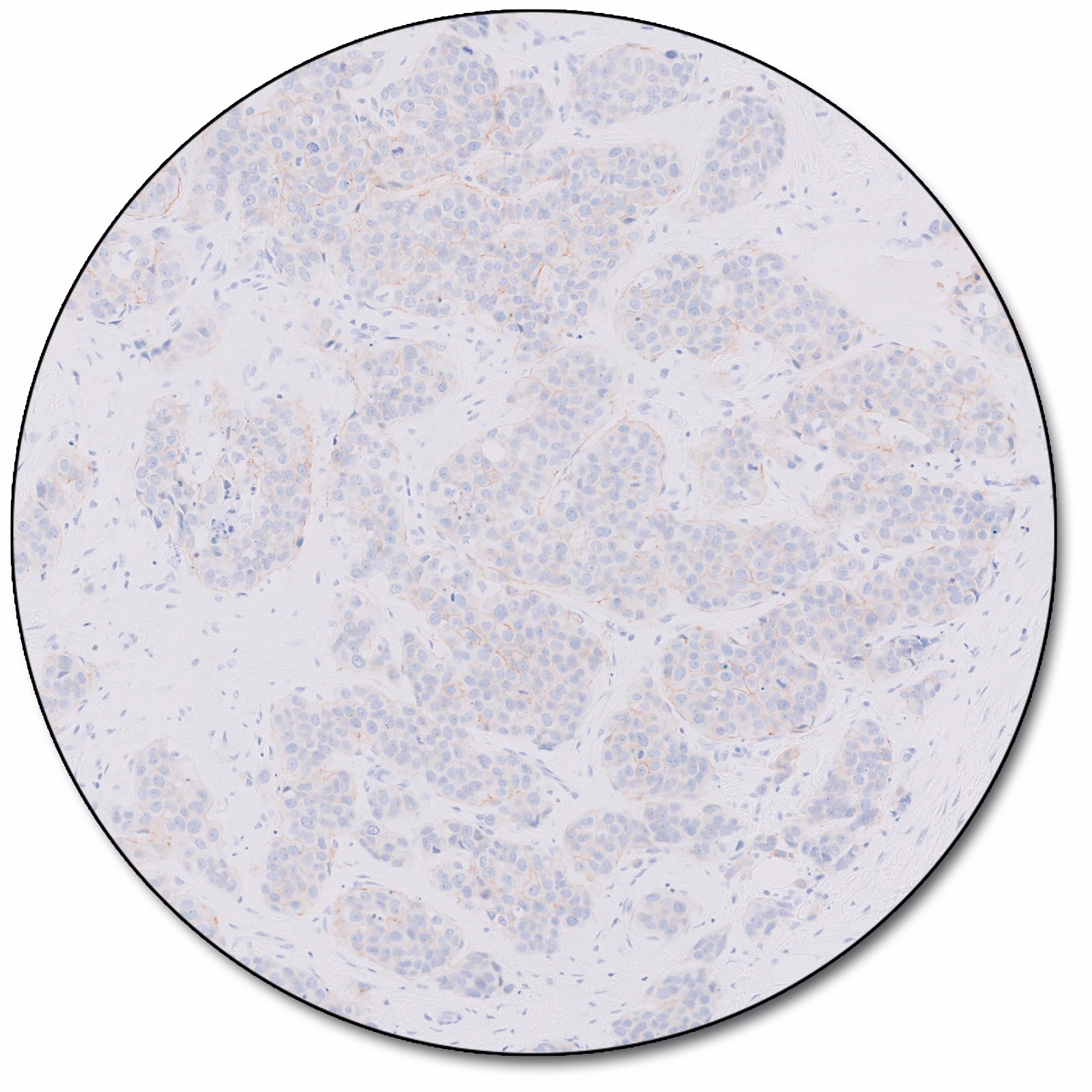 HercepTest™ mAb pharmDx (Dako Omnis)