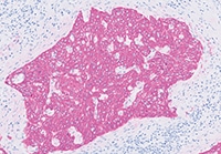 15mar-ca18045-anti-cytokeratin